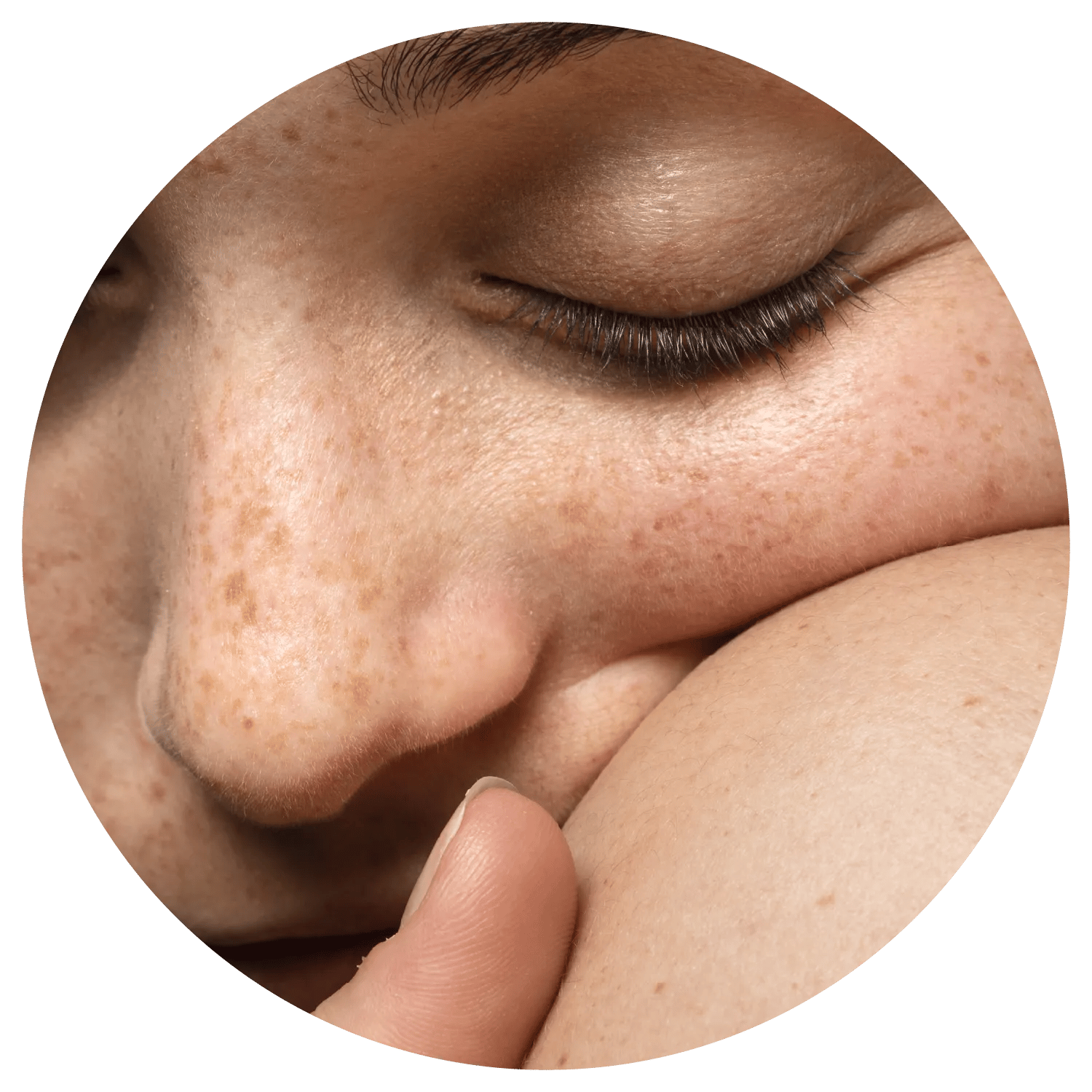 Age Spots treatment process at Toronto medical spa - Why pigmentation is more than skin deep.